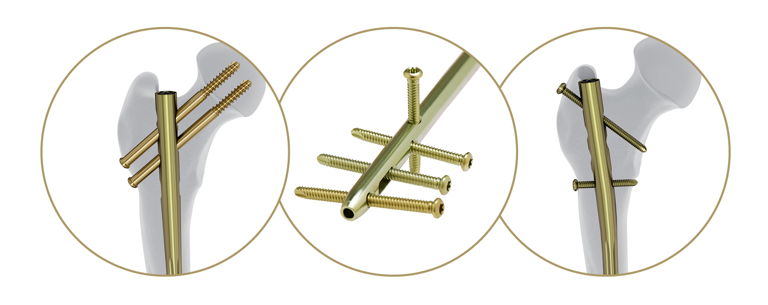 DePuy Synthes Launches Innovative Nailing System Aimed At Improving
